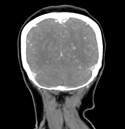 Cerebral arteriovenous malformation (Radiopaedia 73830-84645 C 80).jpg