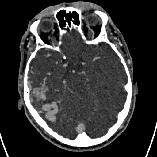 Cerebral arteriovenous malformation (Radiopaedia 78188-90746 Axial C+ delayed 64).jpg