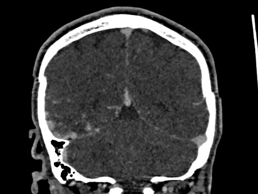Cerebral arteriovenous malformation (Radiopaedia 78188-90746 Coronal C+ delayed 91).jpg