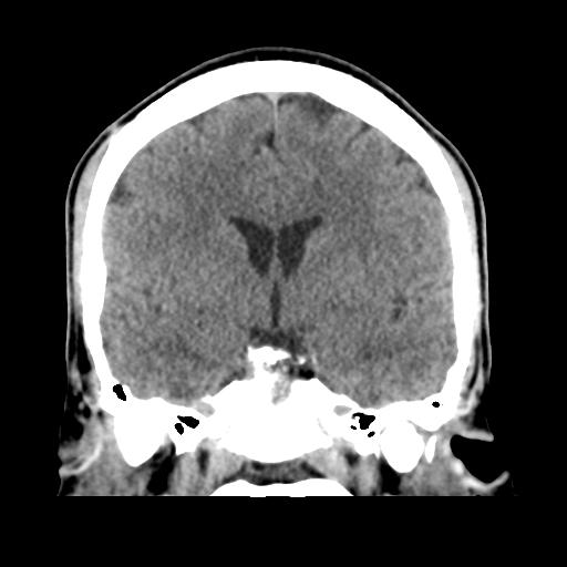 Cerebral arteriovenous malformation (Spetzler-Martin grade 2) (Radiopaedia 41262-44076 Coronal non-contrast 29).png