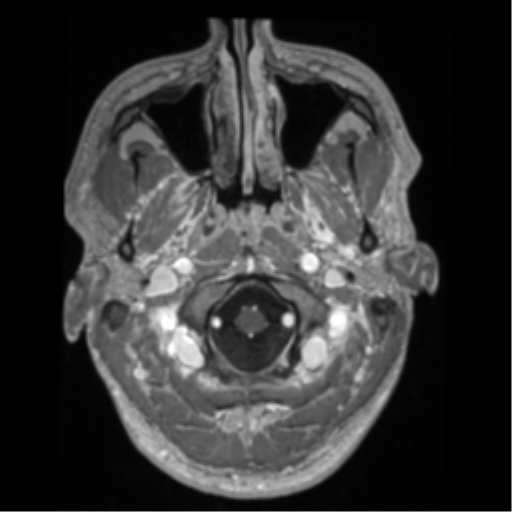 Cerebral arteriovenous malformation - huge (Radiopaedia 35734-37272 Axial T1 C+ 3).png