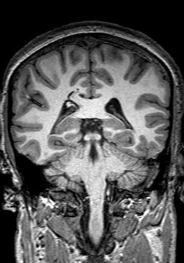 Cerebral arteriovenous malformation at posterior body of corpus callosum (Radiopaedia 74111-84925 Coronal T1 218).jpg