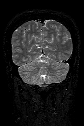 Cerebral arteriovenous malformation at posterior body of corpus callosum (Radiopaedia 74111-84925 Coronal T2 144).jpg