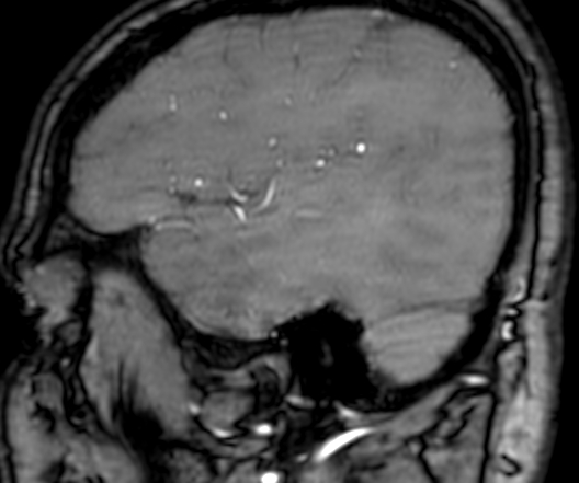 Cerebral arteriovenous malformation at posterior body of corpus callosum (Radiopaedia 74111-84925 J 58).jpg