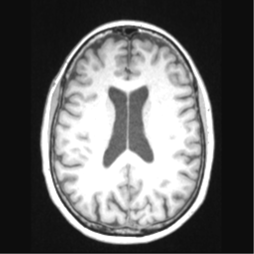 Cerebral arteriovenous malformation with hemorrhage (Radiopaedia 34422-35737 Axial T1 47).png