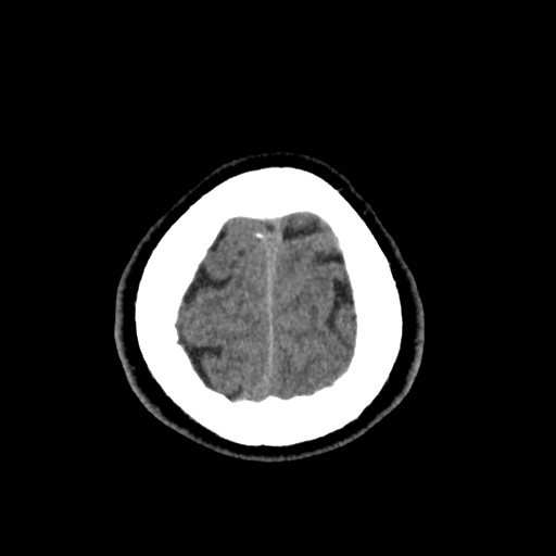 Cerebral arteriovenous malformation with lobar hemorrhage (Radiopaedia 35598-37117 Axial non-contrast 52).jpg