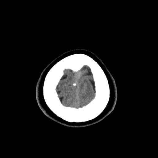 Cerebral arteriovenous malformation with lobar hemorrhage (Radiopaedia 35598-37117 Axial non-contrast 54).jpg