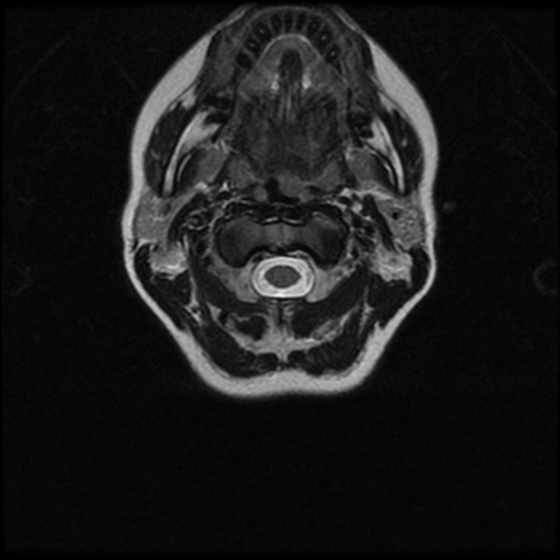 File:Cerebral autosomal dominant arteriopathy with subcortical infarcts and leukoencephalopathy (CADASIL) (Radiopaedia 41018-43763 Ax T2 C2-T1 29).png