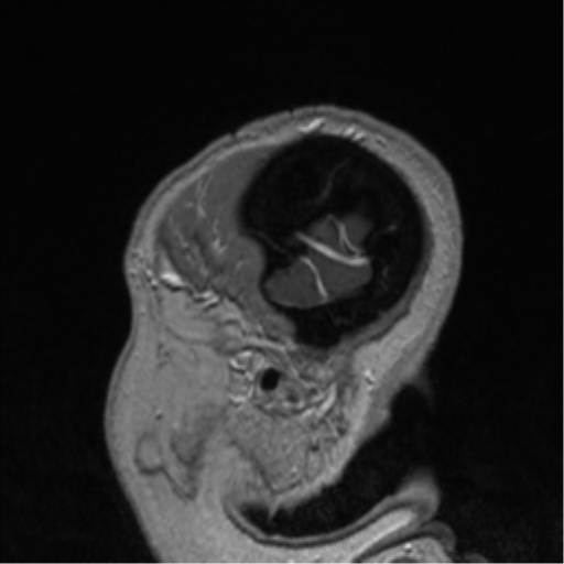 Cerebral cavernoma and development venous anomaly (Radiopaedia 37603-39482 Sagittal T1 C+ 11).png