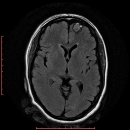 File:Cerebral cavernous malformation (Radiopaedia 26177-26306 FLAIR 11).jpg