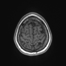 Cerebral cavernous venous malformation (Radiopaedia 70008-80021 Axial T1 83).jpg