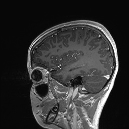 Cerebral cavernous venous malformation (Radiopaedia 70008-80021 Sagittal T1 C+ 53).jpg