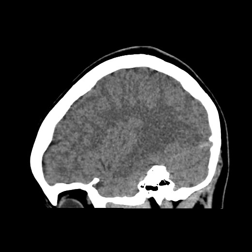 File:Cerebral cavernous venous malformation (Radiopaedia 70008-80022 C 15).jpg