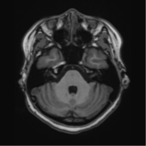 File:Cerebral cavernous venous malformations (Radiopaedia 48117-52946 Axial T1 1).png