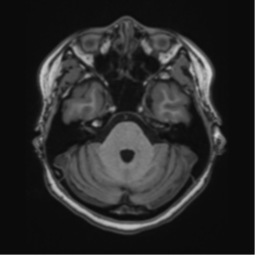 File:Cerebral cavernous venous malformations (Radiopaedia 48117-52946 Axial T1 2).png