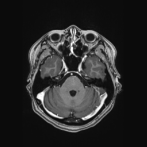 Cerebral cavernous venous malformations (Radiopaedia 48117-52946 Axial T1 C+ 13).png