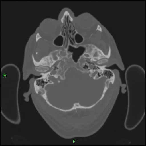 Cerebral contusions (Radiopaedia 33868-35039 Axial bone window 31).jpg