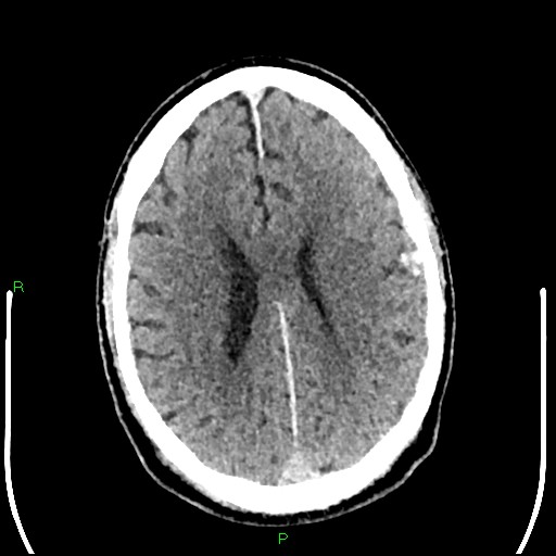 Cerebral contusions (Radiopaedia 33868-35039 Axial non-contrast 141).jpg