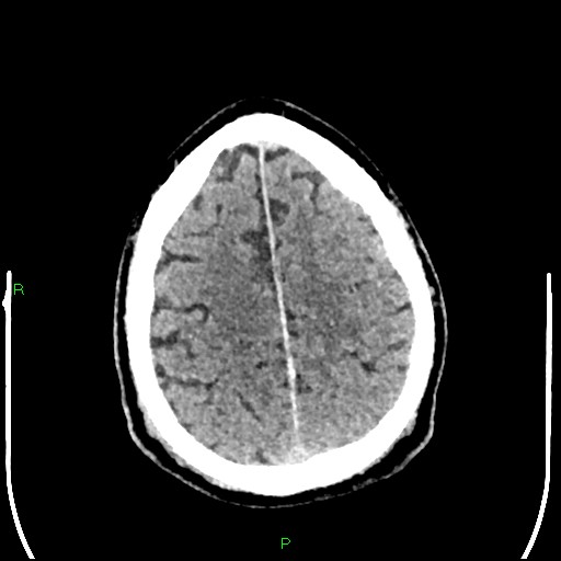 Cerebral contusions (Radiopaedia 33868-35039 Axial non-contrast 173).jpg
