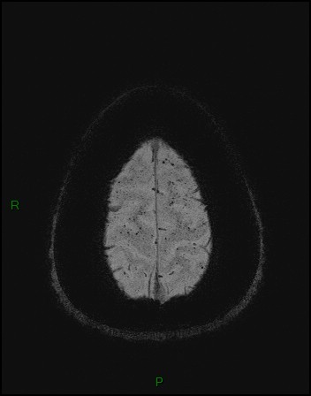 File:Cerebral fat embolism (Radiopaedia 35022-36525 Axial SWI 60).jpg