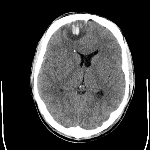 File:Cerebral hemorrhagic contusions- temporal evolution (Radiopaedia 40224-42754 Axial non-contrast 14).png