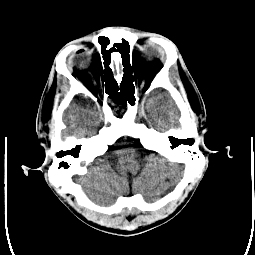 File:Cerebral hemorrhagic contusions- temporal evolution (Radiopaedia 40224-42756 Axial non-contrast 4).png