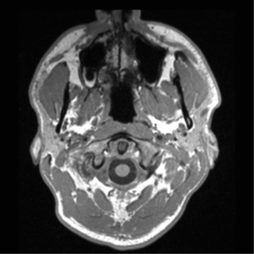 File:Cerebral hemorrhagic contusions- temporal evolution (Radiopaedia 40224-42757 Axial T1 2).png