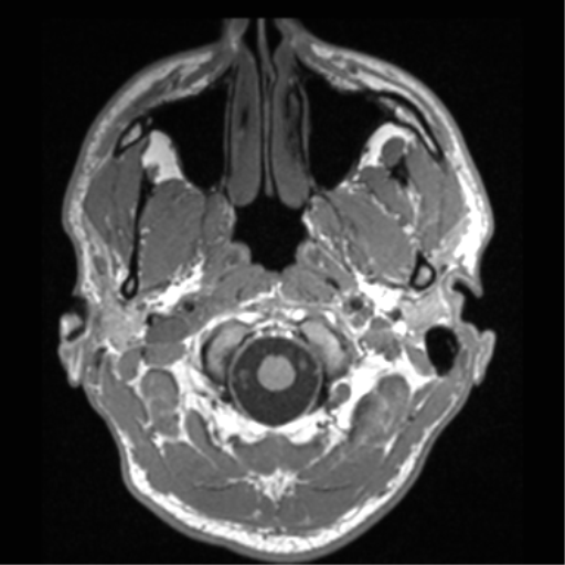 Cerebral hemorrhagic contusions- temporal evolution (Radiopaedia 40224-42757 Axial T1 7).png