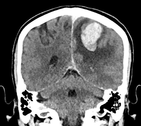 Cerebral metastases - testicular choriocarcinoma (Radiopaedia 84486-99855 D 42).jpg