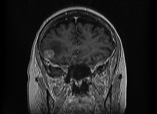 Cerebral metastases from lung cancer with amyloid angiopathy and cerebellopontine angle meningioma (Radiopaedia 74306-85191 Coronal T1 C+ 16).jpg