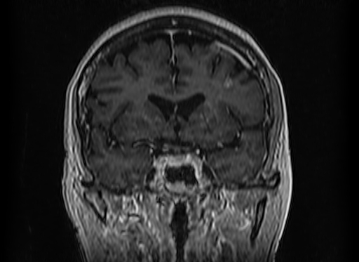 Cerebral metastases from lung cancer with amyloid angiopathy and cerebellopontine angle meningioma (Radiopaedia 74306-85191 Coronal T1 C+ 23).jpg
