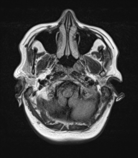 File:Cerebral metastases mimicking abscesses (Radiopaedia 45841-50131 Axial FLAIR 4).png