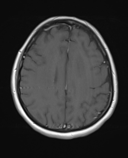 File:Cerebral metastases mimicking abscesses (Radiopaedia 45841-50131 Axial T1 C+ fat sat 20).png