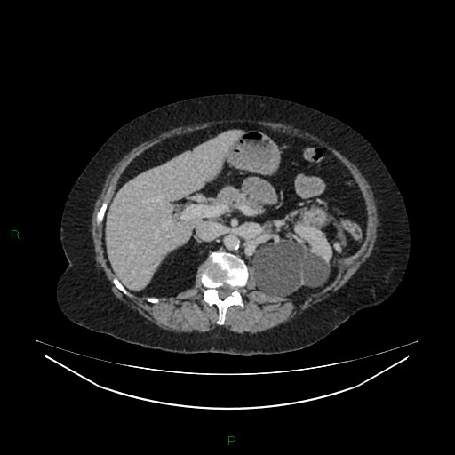 Cerebral metastasis from renal cell carcinoma (Radiopaedia 82306-96378 A 60).jpg