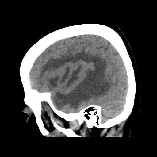 Cerebral metastasis to basal ganglia (Radiopaedia 81568-95412 E 17).png
