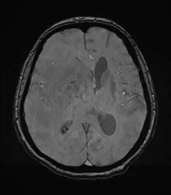 Cerebral metastasis to basal ganglia (Radiopaedia 81568-95413 Axial SWI magnitude 47).png