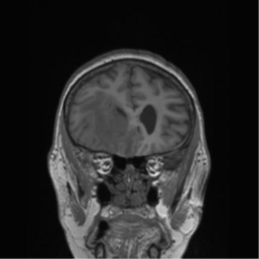 Cerebral metastasis to basal ganglia (Radiopaedia 81568-95413 Coronal T1 46).png