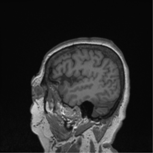 Cerebral metastasis to basal ganglia (Radiopaedia 81568-95413 Sagittal T1 11).png