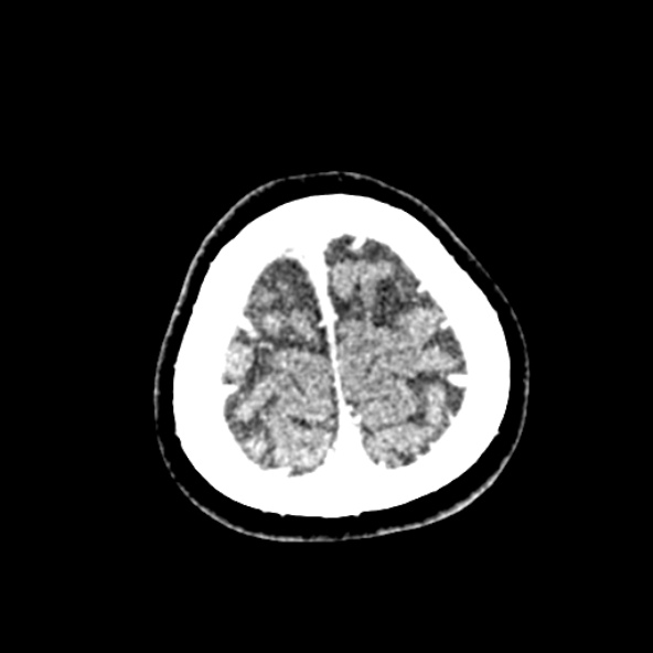 File:Cerebral ring enhancing lesions - cerebral metastases (Radiopaedia 44922-48818 B 262).jpg