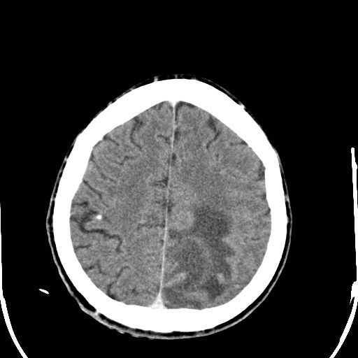 File:Cerebral toxoplasmosis (Radiopaedia 43956-47460 Axial C+ delayed 32).jpg