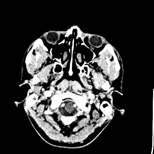 Cerebral toxoplasmosis (Radiopaedia 53993-60131 Axial C+ delayed 7).jpg