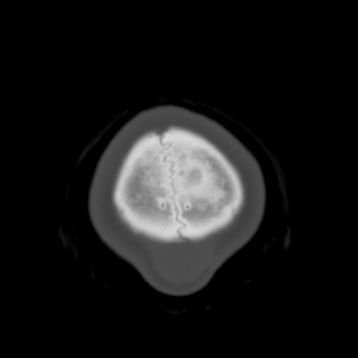Cerebral tuberculosis with dural sinus invasion (Radiopaedia 60353-68018 Axial bone window 65).jpg