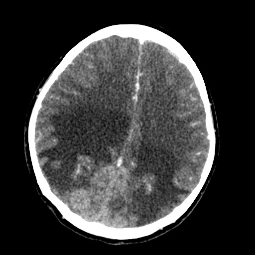 Cerebral tuberculosis with dural sinus invasion (Radiopaedia 60353-68019 Axial C+ delayed 42).jpg