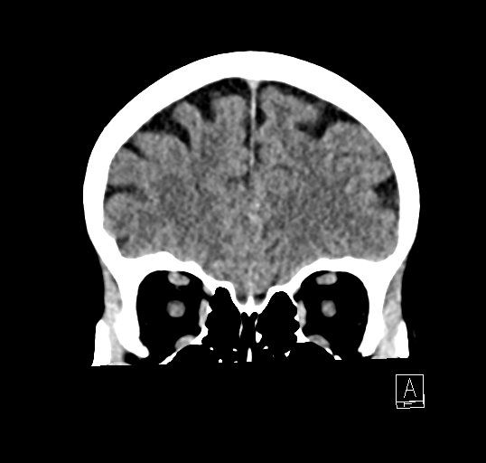 Cerebral venous infarction with hemorrhage (Radiopaedia 65343-74381 Coronal non-contrast 10).jpg