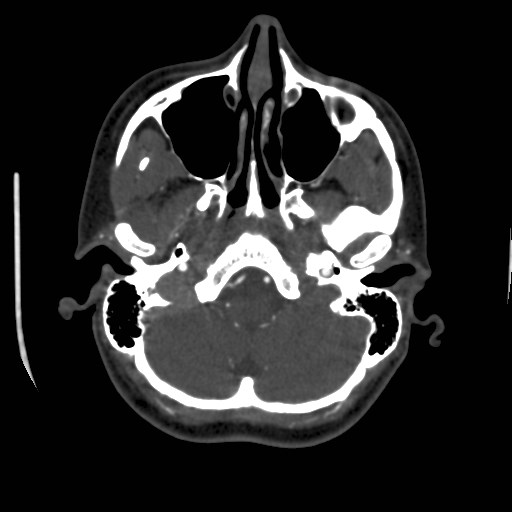Cerebral venous sinus thrombosis (Radiopaedia 40619-43227 A 38).jpg