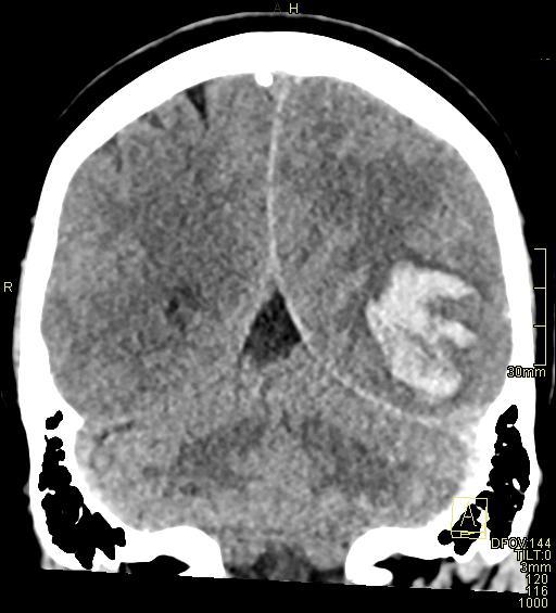 File:Cerebral venous sinus thrombosis (Radiopaedia 91329-108965 Coronal non-contrast 40).jpg