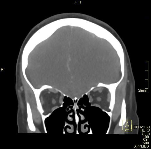 Cerebral venous sinus thrombosis (Radiopaedia 91329-108965 Coronal venogram 23).jpg