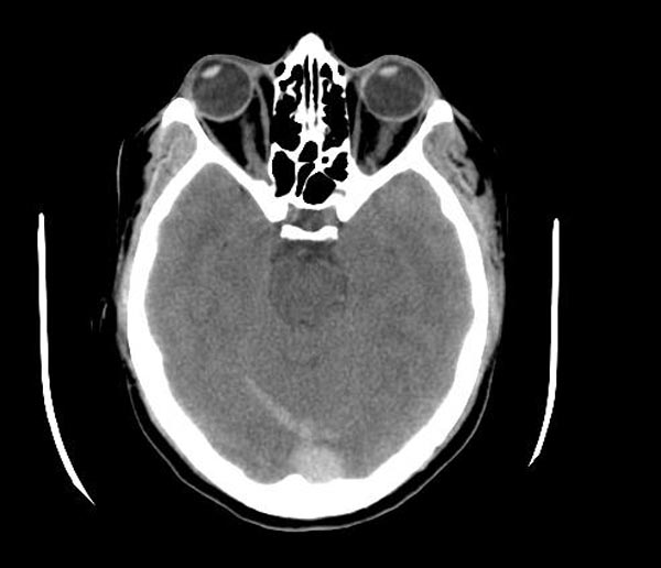 File:Cerebral venous thrombosis (Radiopaedia 11289-11653 Axial 2).jpg