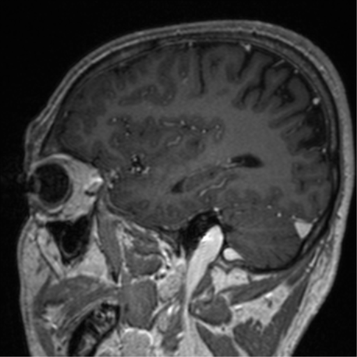File:Cerebral venous thrombosis (Radiopaedia 38392-40469 Sagittal T1 C+ 28).png