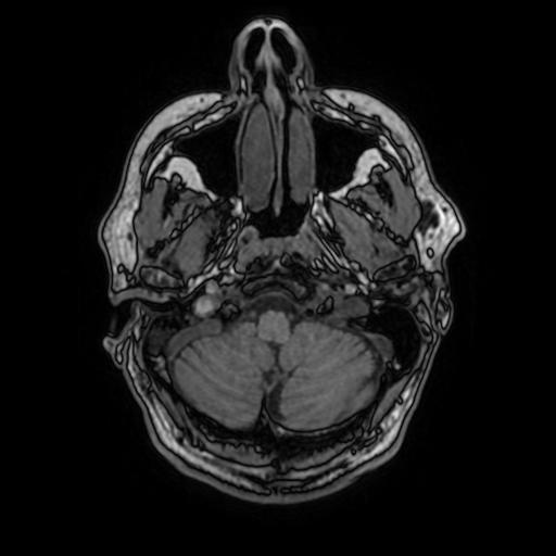 File:Cerebral venous thrombosis with secondary intracranial hypertension (Radiopaedia 89842-106957 Axial T1 41).jpg